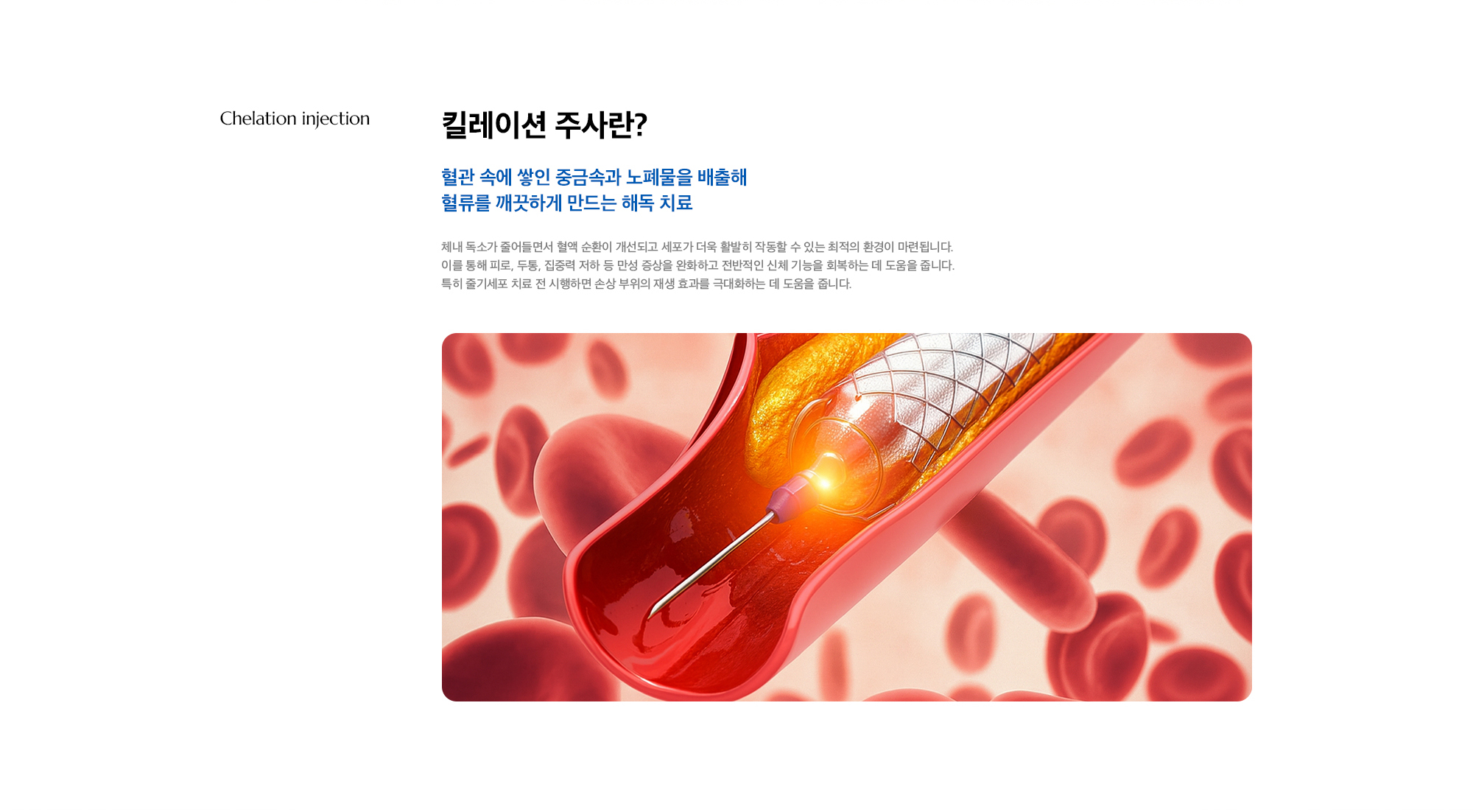 [킬레이션 주사란?] 혈관 속에 쌓인 중금속과 노폐물을 배출해 혈류를 깨끗하게 만드는 해독 치료) 체내 독소가 줄어들면서 혈액 순환이 개선되고 세포가 더욱 활발히 작동할 수 있는 최적의 환경이 마련됩니다. 이를 통해 피로, 두통, 집중력 저하 등 만성 증상을 완화하고 전반적인 신체 기능을 회복하는 데 도움을 줍니다. 특히 줄기세포 치료 전 시행하면 손상 부위의 재생 효과를 극대화하는 데 도움을 줍니다.